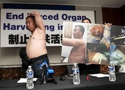 Image for article Laporan Media Internasional tentang Pengambilan Organ Tanpa Persetujuan yang Dilakukan oleh PKT dari Praktisi Falun Gong Cheng Peiming (Bagian 2)